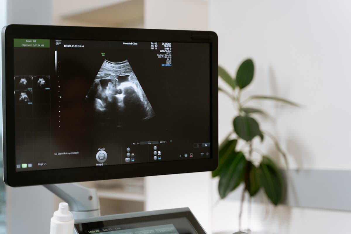 Medical ultrasound scan showing a fetus on a monitor in a clinical setting