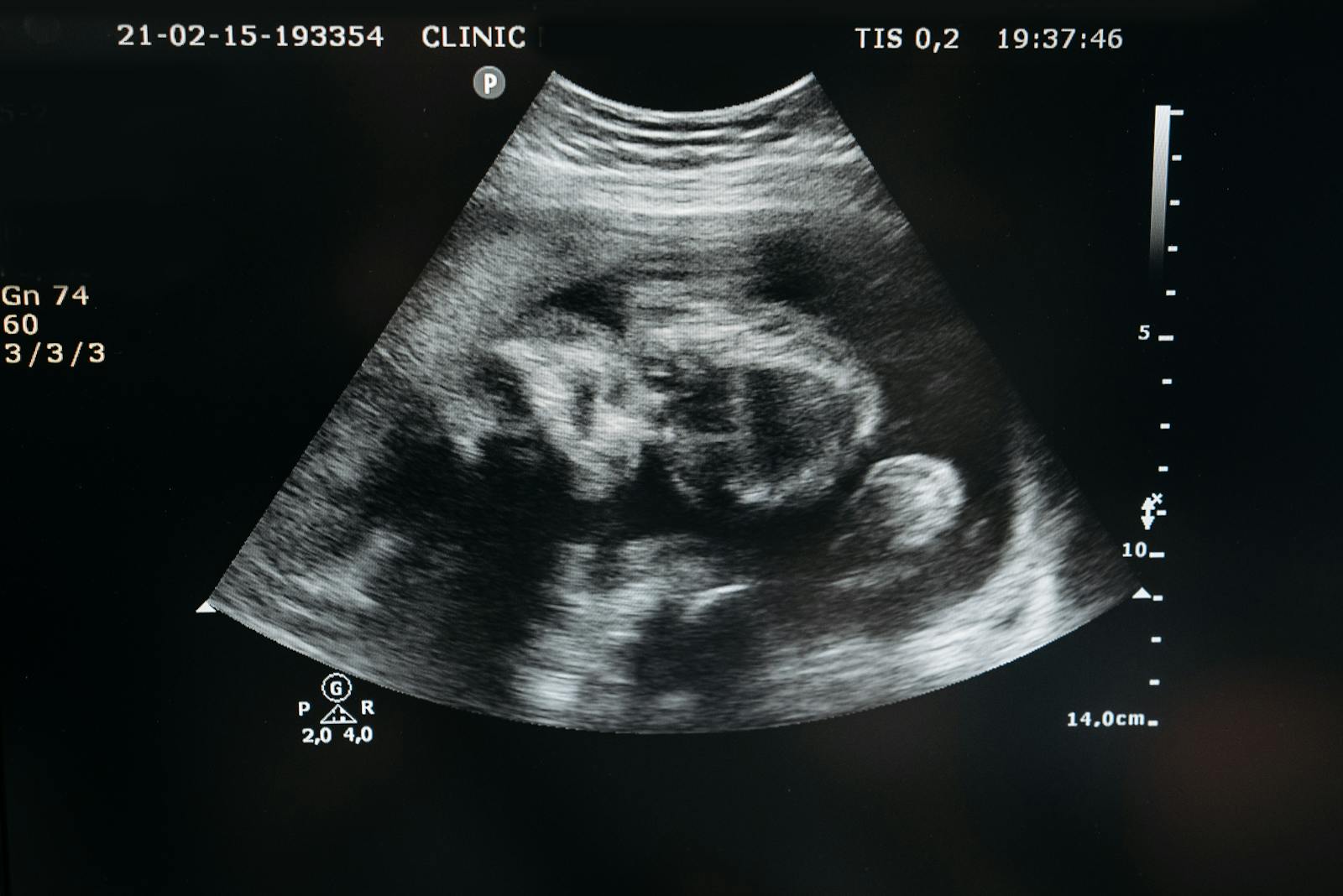 A detailed ultrasound scan showing a fetus during the 20-week anomaly examination